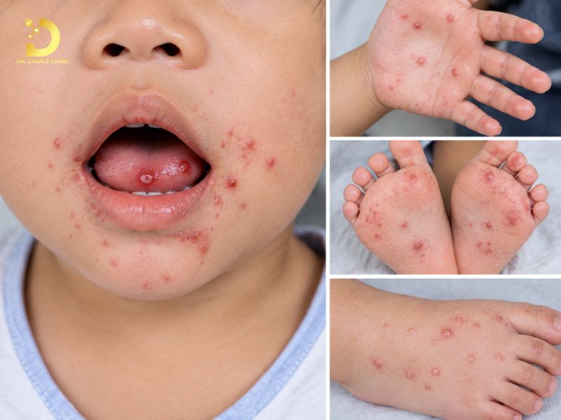 Top 15 Bệnh Ngoài Da Thường Gặp & Cách Phòng Tránh Hiệu Quả 30 Tay chân miệng (Hand, Foot, and Mouth Disease)