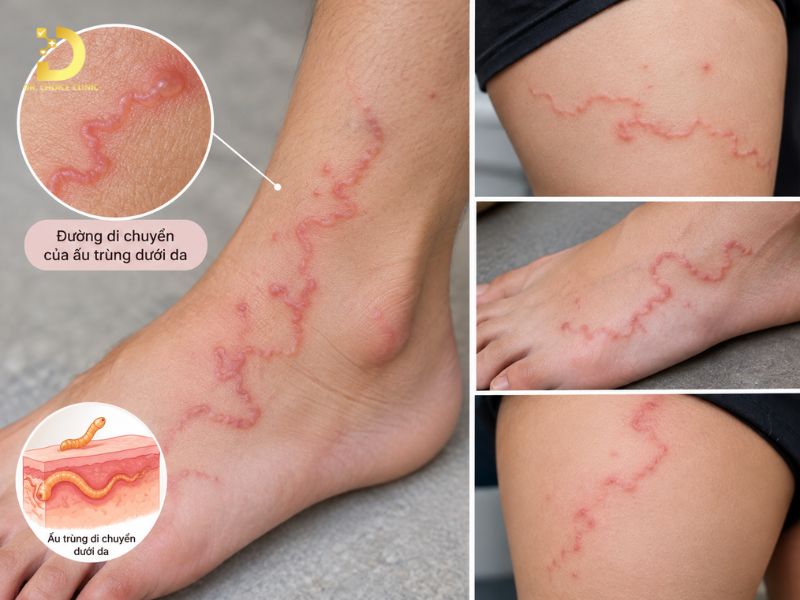 Top 15 Bệnh Ngoài Da Thường Gặp & Cách Phòng Tránh Hiệu Quả 34 Nhiễm ấu trùng di chuyển dưới da