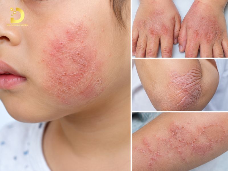 Top 15 Bệnh Ngoài Da Thường Gặp & Cách Phòng Tránh Hiệu Quả 24 Viêm da cơ địa (Chàm/Eczema)