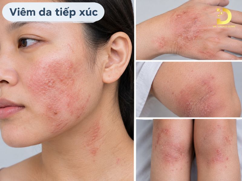 Top 15 Bệnh Ngoài Da Thường Gặp & Cách Phòng Tránh Hiệu Quả 26 Viêm da tiếp xúc