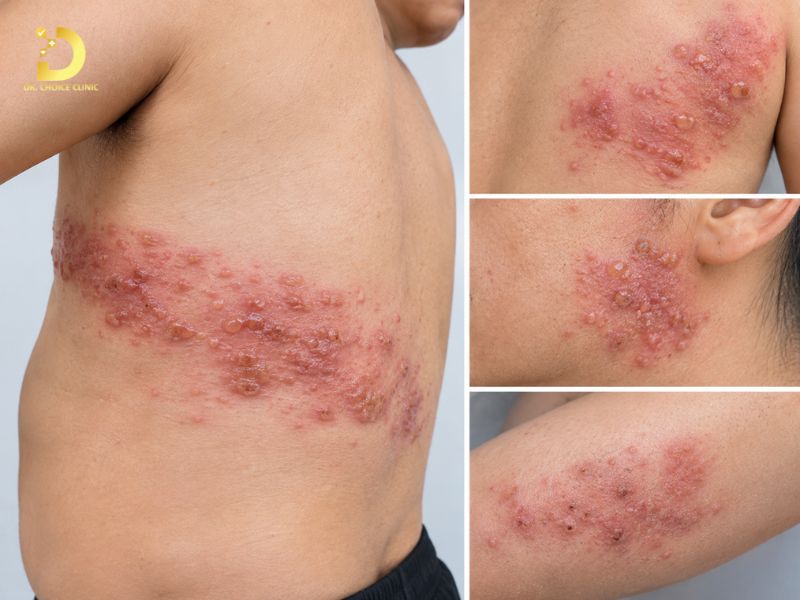 Top 15 Bệnh Ngoài Da Thường Gặp & Cách Phòng Tránh Hiệu Quả 28 Zona thần kinh (Shingles)