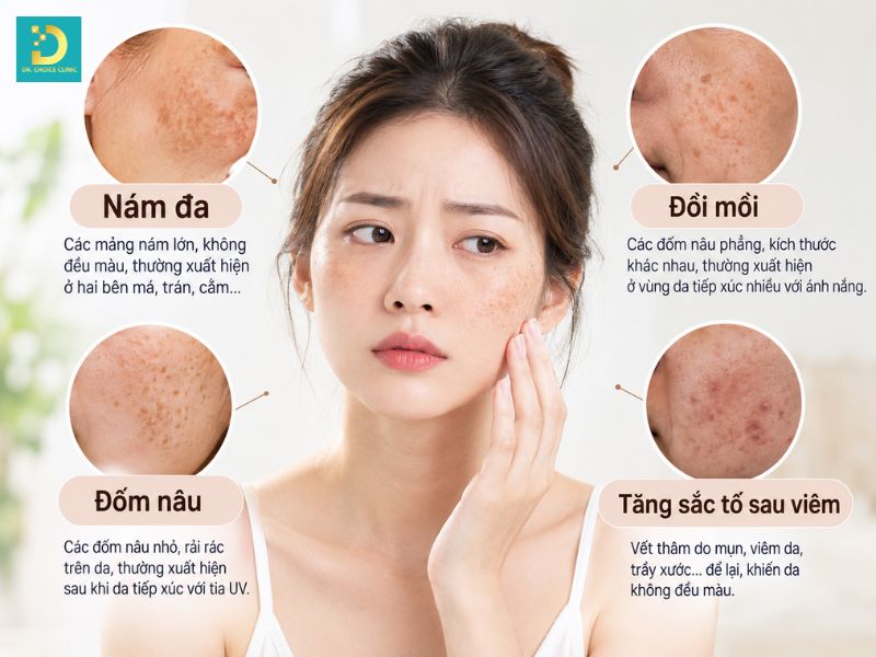 Sắc Tố Melanin: Các Loại, Cơ Chế Hình Thành, Vai Trò & Các Vấn Đề Liên Quan 14 Các vấn đề do tăng sắc tố Melanin