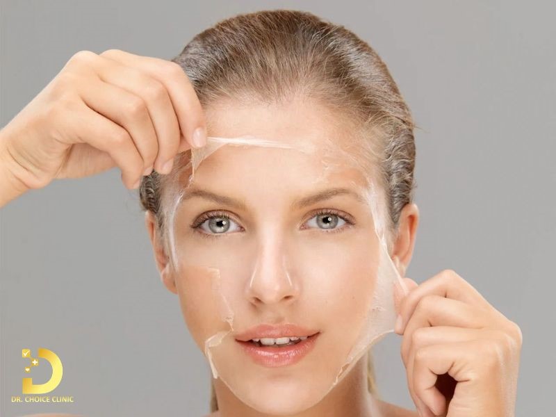 Review Top 5 Công Nghệ Trị Nám Phổ Biến Nhất Hiện Nay 13 Trị nám bằng công nghệ Peel da hóa học (ảnh minh họa)