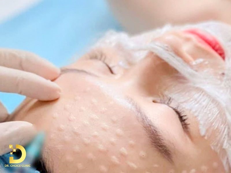Review Top 5 Công Nghệ Trị Nám Phổ Biến Nhất Hiện Nay 12 Trị nám bằng công nghệ Mesotherapy (ảnh minh họa)