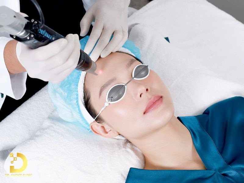 Review Top 5 Công Nghệ Trị Nám Phổ Biến Nhất Hiện Nay 9 Trị nám bằng công nghệ Pico Laser (ảnh minh họa)