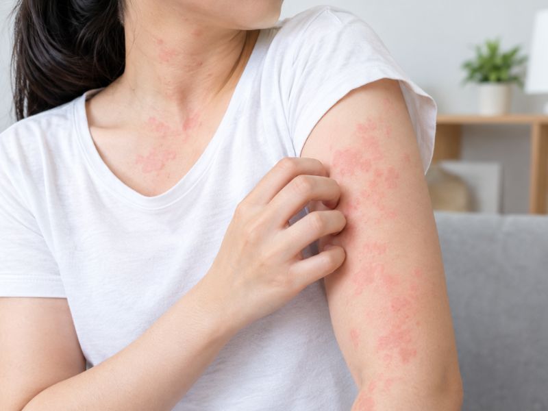Ngứa Da: Nguyên Nhân, Phân Loại, Cách Nhận Biết Và Chăm Sóc Đúng Cách 13 Ngứa da do mề đay