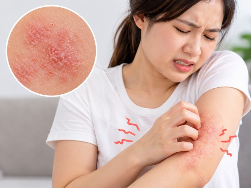 Ngứa Da: Nguyên Nhân, Phân Loại, Cách Nhận Biết Và Chăm Sóc Đúng Cách 12 Ngứa da do viêm da cơ địa
