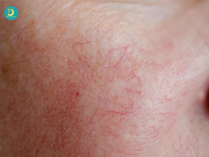 Da Bị Mỏng Nổi Mạch Máu: Nguyên Nhân & Cách Phục Hồi Hiệu Quả 9 Da mỏng nổi mạch máu (ảnh minh họa)